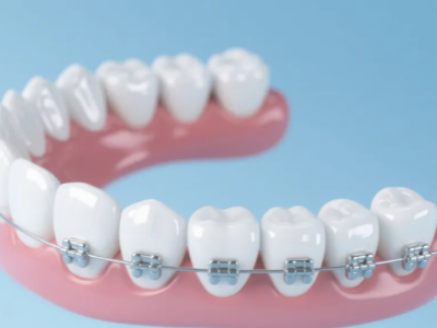 想做牙齒矯正，哪種方案更適合你？