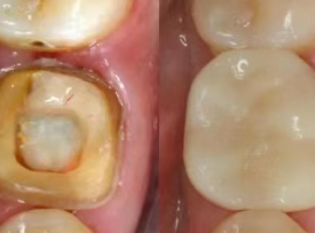 根管治療（抽神經(jīng)）后，為什么一定要做牙冠？