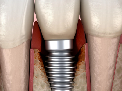 種植牙的術(shù)前準(zhǔn)備有哪些？