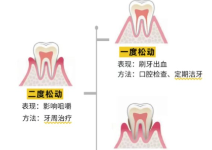 老年人牙齒松動(dòng)了要怎么辦？