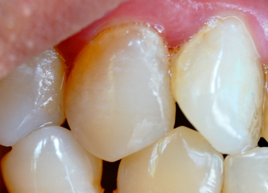 牙齒表面的牙釉質(zhì)掉了還可以修復(fù)嗎？