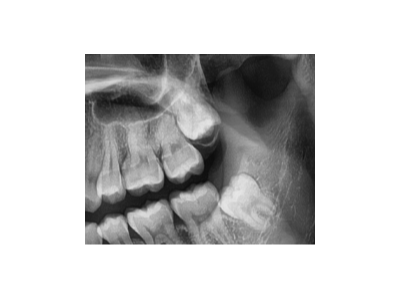 既然「智齒」不宜久留，為什么不能一次性拔掉？