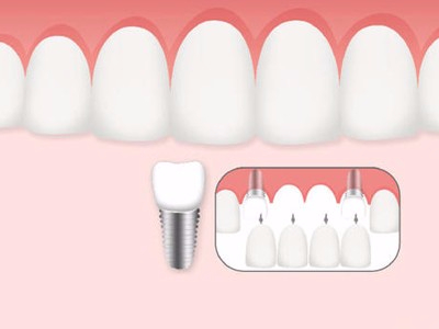 惟德口腔口腔種植怎么樣？惟德口腔就來為您一一解答