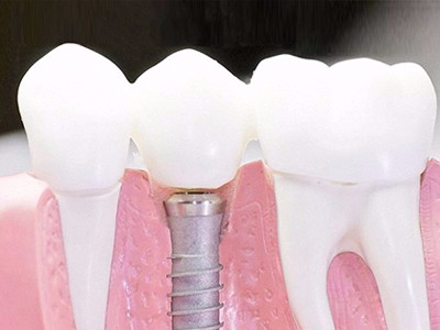 在承德口腔種植齒需要多少錢？惟德口腔一一為您道來