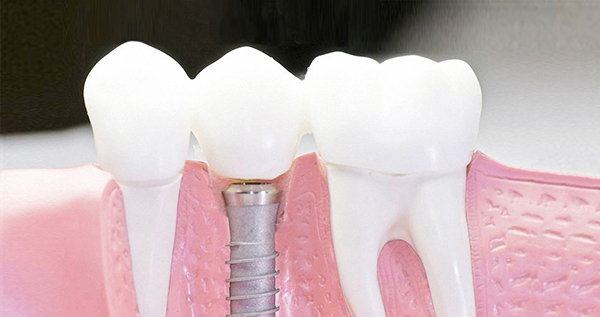 在承德口腔種植牙齒需要多少錢？惟德口腔一一為您道來(lái)