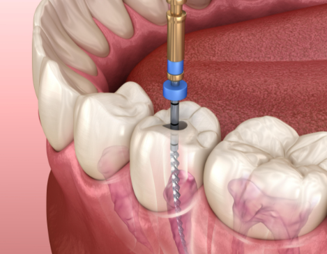 根管治療后的注意事項(xiàng)有哪些？