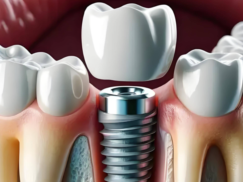 對于老年人來說，裝假牙和種植牙哪個更好